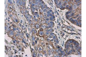 IHC-P Image IL3 Receptor alpha antibody [N2C2], Internal detects IL3 Receptor alpha protein at cell membrane and cytoplasm in human esophageal cancer by immunohistochemical analysis. (IL3RA 抗体)