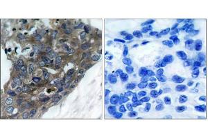 Immunohistochemical analysis of paraffin-embedded human breast carcinoma tissue, using ASK1 (Ab-966) antibody (E021134). (ASK1 抗体)