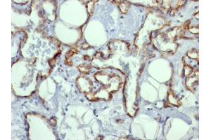 Formalin-fixed, paraffin-embedded human Angiosarcoma stained with CD31 Mouse Monoclonal Antibody (C31. (CD31 抗体)