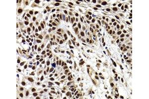 Immunohistochemistry of paraffin-embedded Human well-differentiated squamous skin carcinoma using HIRIP3 Polyclonal Antibody at dilution of 1:100 (40x lens). (HIRIP3 抗体)