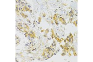 Immunohistochemistry of paraffin-embedded human breast cancer using EIF4G1 Antibody. (EIF4G1 抗体)