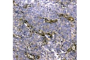 IHC testing of FFPE human lung cancer tissue with MYBPC3 antibody at 1ug/ml. (MYBPC3 抗体)