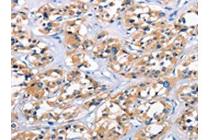 The image on the left is immunohistochemistry of paraffin-embedded Human thyroid cancer tissue using ABIN7189861(APOL6 Antibody) at dilution 1/50, on the right is treated with synthetic peptide. (APOL6 抗体)