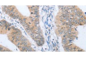 Immunohistochemistry of paraffin-embedded Human colon cancer tissue using CHRNA10 Polyclonal Antibody at dilution 1:50 (CHRNA10 抗体)
