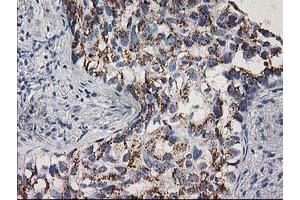 Immunohistochemical staining of paraffin-embedded Carcinoma of Human lung tissue using anti-CDK2 mouse monoclonal antibody. (CDK2 抗体)