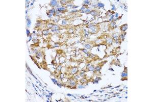 Immunohistochemistry of paraffin-embedded human breast cancer using NDE1 antibody. (NDE1 抗体  (AA 1-110))