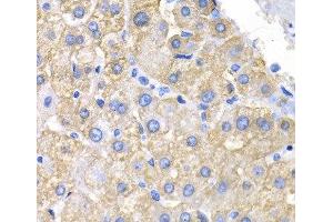 Immunohistochemistry of paraffin-embedded Human liver cancer using CRK Polyclonal Antibody at dilution of 1:200 (40x lens). (Crk 抗体)