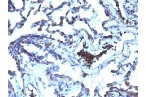 IHC testing of FFPE human lung carcinoma with TDP2 antibody (clone TDP2/1258). (TDP2 抗体)