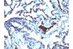 IHC testing of FFPE human lung carcinoma with TDP2 antibody (clone TDP2/1258).