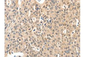 The image on the left is immunohistochemistry of paraffin-embedded Human ovarian cancer tissue using ABIN7192211(ROS1 Antibody) at dilution 1/40, on the right is treated with synthetic peptide. (ROS1 抗体)