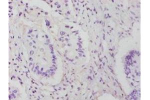 Immunohistochemistry of paraffin-embedded human colon cancer using ABIN7142748 at dilution of 1:25 (RPL14 抗体  (AA 2-214))