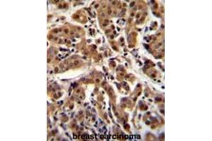 AKT1 Antibody (C-term T450) immunohistochemistry analysis in formalin fixed and paraffin embedded human breast carcinoma followed by peroxidase conjugation of the secondary antibody and DAB staining. (AKT1 抗体  (C-Term))