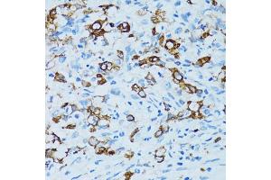 Immunohistochemistry of paraffin-embedded human uterine cancer using CTSE antibody. (Cathepsin E 抗体)