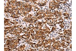 The image on the left is immunohistochemistry of paraffin-embedded Human breast cancer tissue using ABIN7192115(Rab3D Antibody) at dilution 1/27, on the right is treated with synthetic peptide. (RAB3D 抗体)