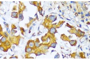 Immunohistochemistry of paraffin-embedded Human lung cancer using AARS Polyclonal Antibody at dilution of 1:100 (40x lens). (AARS 抗体)