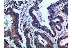 Immunohistochemical analysis of paraffin-embedded Human-colon-cancer, antibody was diluted at 1:100 (IL17F 抗体  (AA 81-130))