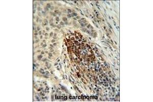 MF Antibody (C-term) 940b IHC analysis in formalin fixed and paraffin embedded human lung carcinoma followed by peroxidase conjugation of the secondary antibody and DAB staining. (MFAP4 抗体  (C-Term))