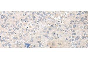Immunohistochemistry of paraffin-embedded Human cervical cancer tissue using TUBG2 Polyclonal Antibody at dilution of 1:50(x200) (TUBG2 抗体)