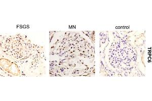 Expression of TRPC6 in human kidney from MN patientsImmunohistochemical staining of human biopsy specimens from MN patients, FSGS patients, and normal kidney tissue from tumor nephrectomy samples using Anti-TRPC6 Antibody (ABIN7043824, ABIN7043968 and ABIN7043969).
