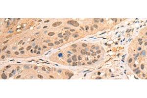 Immunohistochemistry of paraffin-embedded Human esophagus cancer tissue using BPGM Polyclonal Antibody at dilution of 1:70(x200) (BPGM 抗体)