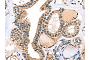 The image on the left is immunohistochemistry of paraffin-embedded Human thyroid cancer tissue using ABIN7130823(RASGEF1A Antibody) at dilution 1/20, on the right is treated with fusion protein. (RASGEF1A 抗体)