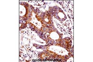 CEAC Antibody (Center) ((ABIN1537760 and ABIN2848792))immunohistochemistry analysis in formalin fixed and paraffin embedded human colon carcinoma followed by peroxidase conjugation of the secondary antibody and DAB staining. (CEACAM7 抗体  (AA 112-140))
