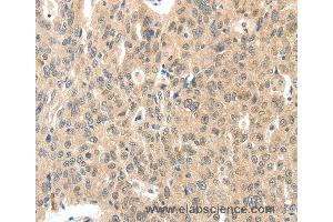 Immunohistochemistry of Human ovarian cancer using ROS1 Polyclonal Antibody at dilution of 1:40 (ROS1 抗体)