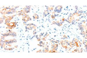 Immunohistochemistry of paraffin-embedded Human colon cancer tissue using CCDC88A Polyclonal Antibody at dilution 1:50 (Girdin 抗体)