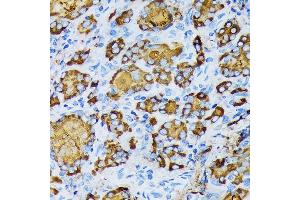 Immunohistochemistry of paraffin-embedded human thyroid cancer using γ-Tubulin Rabbit mAb (ABIN7271052) at dilution of 1:100 (40x lens). (TUBG1 抗体)