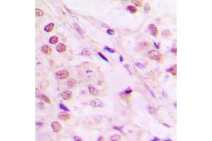 Immunohistochemical analysis of TCEB3 staining in human lung cancer formalin fixed paraffin embedded tissue section.