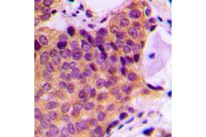 Immunohistochemical analysis of JNK1/2/3 (pT183) staining in human breast cancer formalin fixed paraffin embedded tissue section. (JNK 抗体  (pSer183))