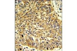 Formalin-fixed and paraffin-embedded human lung carcinoma reacted with RGP1 Antibody (C-term), which was peroxidase-conjugated to the secondary antibody, followed by DAB staining. (RGP1 抗体  (C-Term))
