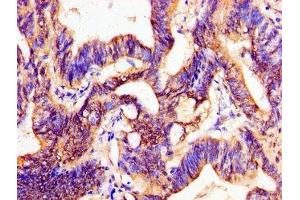 Immunohistochemistry of paraffin-embedded human colon cancer using ABIN7162750 at dilution of 1:100 (PTX3 抗体  (AA 99-164))
