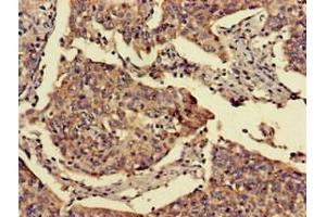 Immunohistochemistry of paraffin-embedded human cervical cancer using ABIN7153070 at dilution of 1:100 (FOXN1 抗体  (AA 1-160))