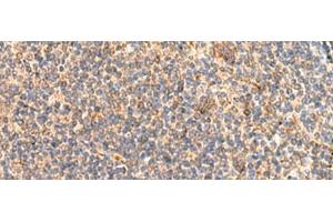 Immunohistochemistry of paraffin-embedded Human tonsil tissue using ABHD2 Polyclonal Antibody at dilution of 1:40(x200) (ABHD2 抗体)
