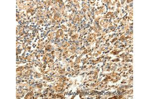 Immunohistochemistry of Human gastric cancer using SLC25A11 Polyclonal Antibody at dilution of 1:30 (SLC25A11 抗体)