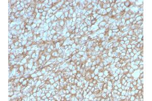Formalin-fixed, paraffin-embedded human Melanoma stained with MCAM Mouse Monoclonal Antibody (MCAM/3048). (MCAM 抗体  (AA 226-374))