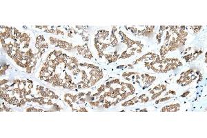 Immunohistochemistry of paraffin-embedded Human esophagus cancer tissue using ZNF248 Polyclonal Antibody at dilution of 1:25(x200) (ZNF248 抗体)
