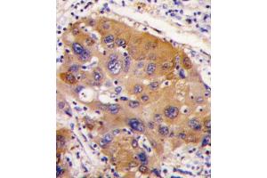 Formalin-fixed and paraffin-embedded human hepatocarcinoma tissue reacted with NNMT antibody (Center) (ABIN387867 and ABIN2844050) , which was peroxidase-conjugated to the secondary antibody, followed by DAB staining. (NNMT 抗体  (AA 77-106))