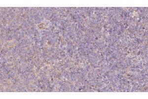 ABIN6273066 at 1/100 staining Human lymph cancer tissue by IHC-P. (PPPDE1 抗体  (Internal Region))