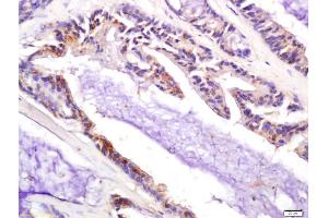 Formalin-fixed and paraffin embedded human colon carcinoma labeled with Anti-P21 Polyclonal Antibody, Unconjugated (ABIN1714474) at 1:200 followed by conjugation to the secondary antibody and DAB staining (p21 抗体  (AA 21-100))