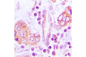 Immunohistochemical analysis of OTUB2 staining in human lung cancer formalin fixed paraffin embedded tissue section. (OTUB2 抗体  (Center))
