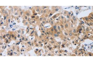 Immunohistochemistry of paraffin-embedded Human lung cancer tissue using NEB Polyclonal Antibody at dilution 1:80 (Nebulin 抗体)