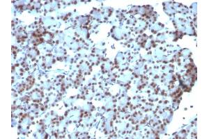 Formalin-fixed, paraffin-embedded human Ovarian Carcinoma stained with SUMO-1 Monoclonal Antibody (SUMO1/1188) (SUMO1 抗体)