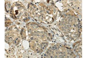 The image on the left is immunohistochemistry of paraffin-embedded Human breast cancer tissue using ABIN7128017(SIAH1 Antibody) at dilution 1/35, on the right is treated with fusion protein. (SIAH1 抗体)
