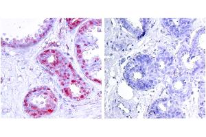 P-Peptide - +Immunohistochemical analysis of paraffin-embedded human breast carcinoma tissue using c-Jun (phospho-Ser243) antibody. (C-JUN 抗体  (pSer243))
