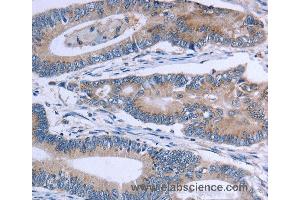 Immunohistochemistry of Human colon cancer using SLC1A6 Polyclonal Antibody at dilution of 1:40 (SLC1A6 抗体)