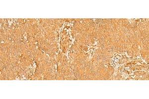Immunohistochemistry of paraffin-embedded Human breast cancer tissue using KRT76 Polyclonal Antibody at dilution of 1:50(x200) (Cytokeratin 2 抗体)