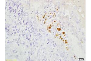 Formalin-fixed and paraffin embedded human endometrial cancer labeled with Anti-S100B/S100 beta Polyclonal Antibody, Unconjugated (ABIN1387393) followed by conjugation to the secondary antibody and DAB staining