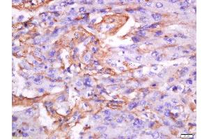Paraformaldehyde-fixed, paraffin embedded human lung carcinoma tissue, Antigen retrieval by boiling in sodium citrate buffer(pH6) for 15min, Block endogenous peroxidase by 3% hydrogen peroxide for 30 minutes, Blocking buffer (normal goat serum) at 37°C for 20min, Antibody incubation with Rabbit Anti-Exportin-2 Polyclonal Antibody, Unconjugated  at 1:200 overnight at 4°C, followed by a conjugated secondary and DAB staining (Exportin 2 抗体  (AA 901-971))